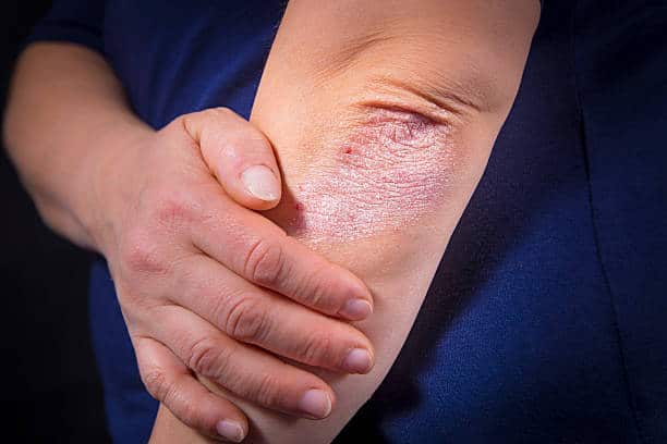 Magnétiseur pour Psoriasis